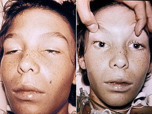 Clinical image of botulism patient with flaccid paralysis