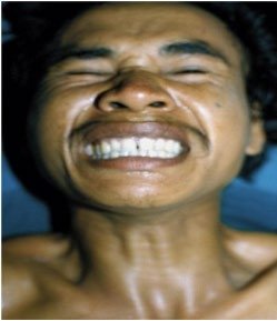 Clinical image of tetanus patient with muscle spasms