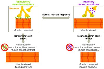Diagram comparing spastic and flaccid paralysis