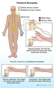 Diagram of peripheral neuropathy showing affected nerves and symptoms
