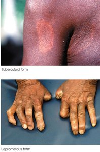 Clinical images of tuberculoid and lepromatous leprosy