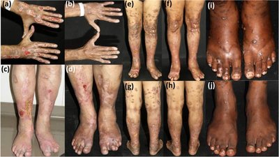 Clinical images showing complications of leprosy