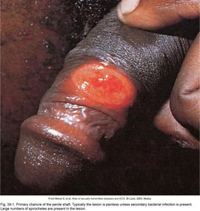 Primary syphilitic chancre on penis