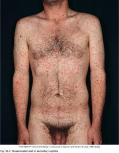 Disseminated rash in secondary syphilis
