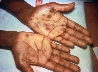 Secondary syphilis rash on palms