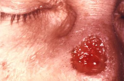 Gumma on face in tertiary syphilis