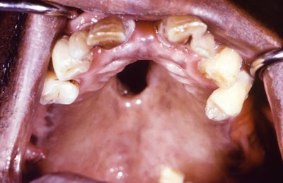 Gumma in oral cavity