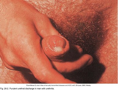 Purulent urethral discharge in man with urethritis