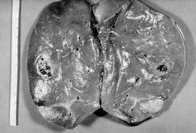 Gumma in liver tissue
