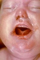 Congenital syphilis with facial deformities