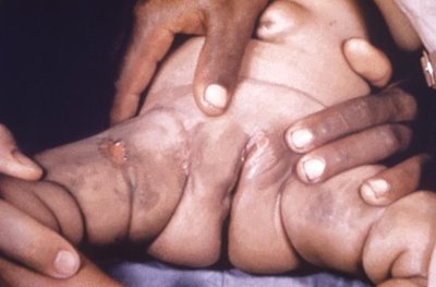 Congenital syphilis with rhagades (mouth fissures)