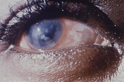 Hutchinson teeth in congenital syphilis