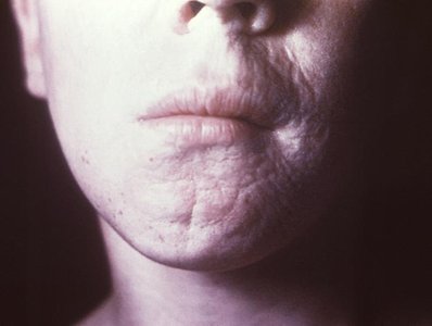 Interstitial keratitis in congenital syphilis