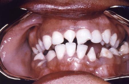 Rhagades (mouth fissures) in congenital syphilis