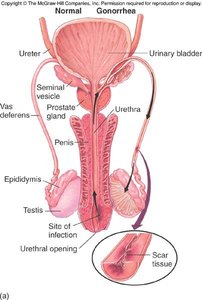 Diagram of male reproductive tract showing site of gonococcal infection and scarring
