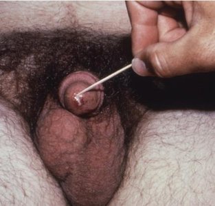 Urethral swab for diagnosis of gonorrhea