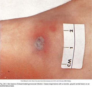 Skin lesion of disseminated gonococcal infection