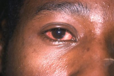 Conjunctivitis as extragenital manifestation of gonorrhea