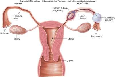 Diagram of female reproductive tract showing PID and complications of gonorrhea