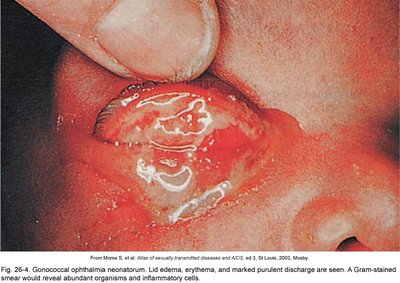 Gonococcal ophthalmia neonatorum in newborn
