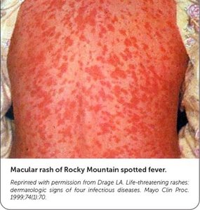 Macular rash as a sign of infectious disease