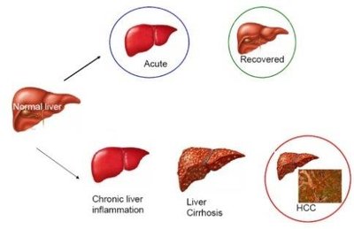 Liver disease progression: acute, chronic, cirrhosis, cancer