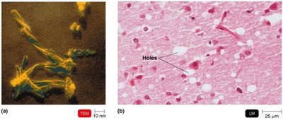 TEM and LM of spongiform encephalopathies showing holes in brain tissue