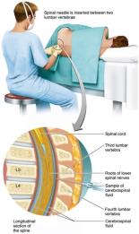 Spinal tap (lumbar puncture) procedure