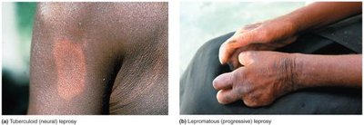 Photos of tuberculoid and lepromatous leprosy lesions