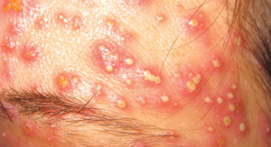 Pustule: raised lesion with pus