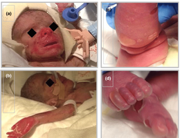 SSSS: Staphylococcal Scalded Skin Syndrome in pediatric patients