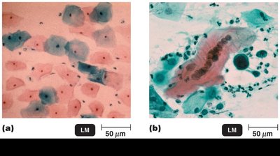 Light micrographs of normal and cancerous cervical cells