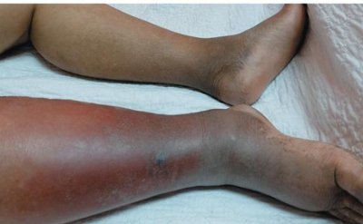 Cellulitis on the leg