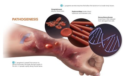 Advanced necrotizing fasciitis