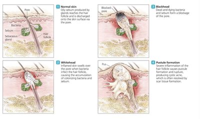 Development of acne: normal skin, blackhead, whitehead, pustule
