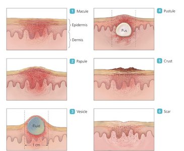 Monkeypox lesions on the skin