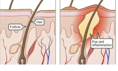 Diagram of folliculitis showing pus and inflammation