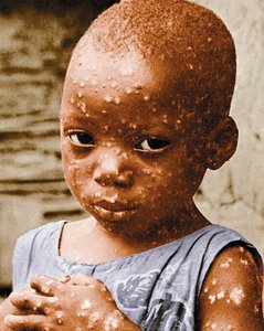 Child with smallpox