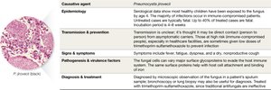 Pneumocystis pneumonia disease snapshot table
