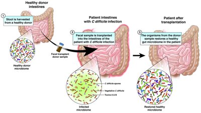 Fecal microbiota transplantation process