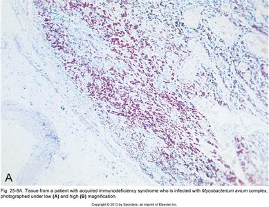 Tissue from a patient with AIDS infected with Mycobacterium avium complex