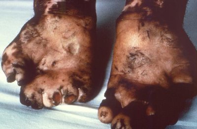 Lepromatous leprosy affecting feet