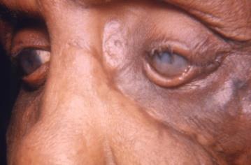 Lepromatous leprosy affecting face
