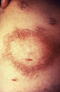 Lepromatous leprosy skin lesion