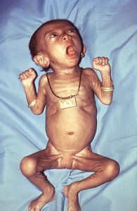 Bordetella pertussis infection in infant