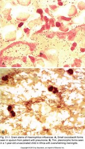 Gram stain of Haemophilus influenzae