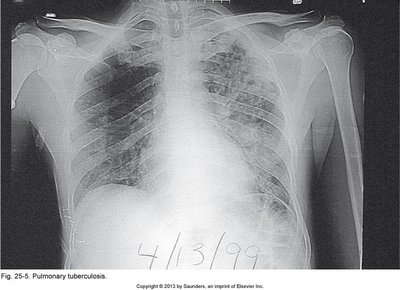 Pulmonary tuberculosis X-ray