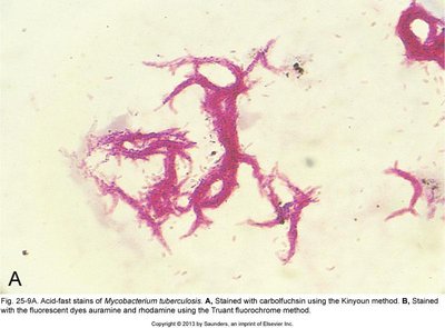 Acid-fast stain of Mycobacterium tuberculosis (carbolfuchsin)