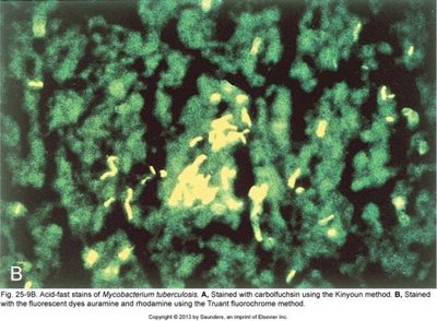Acid-fast stain of Mycobacterium tuberculosis (fluorochrome)