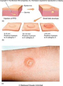 Mantoux test for tuberculosis